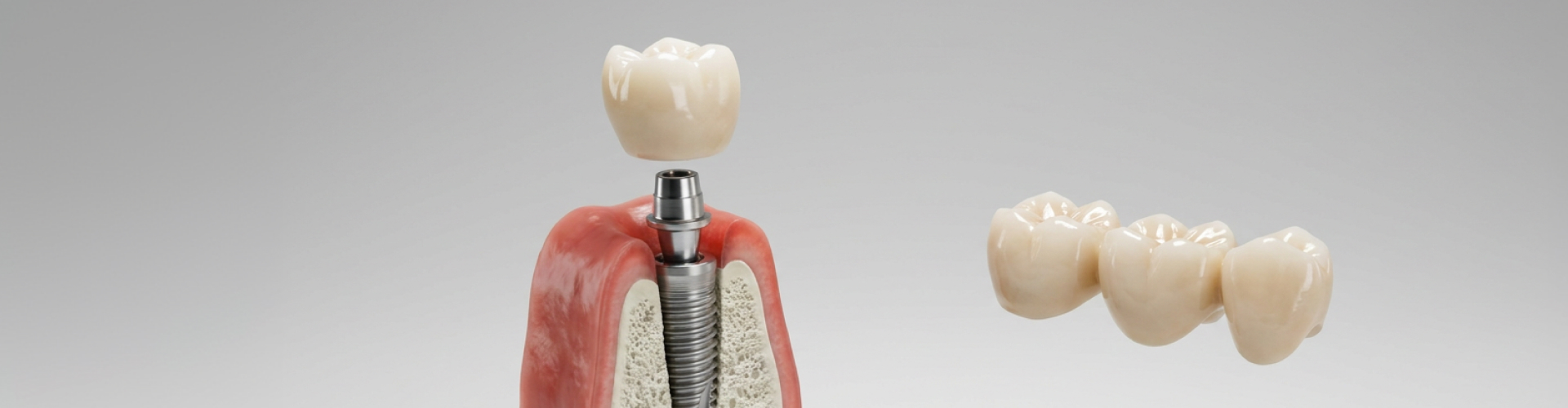 Model jaw section with dental implant and crown.